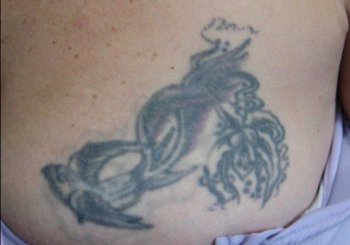 Удаление татуировки. До лечения